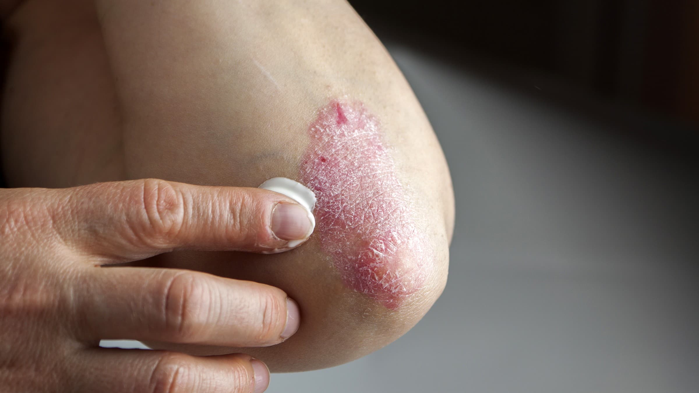 Mild Plaque Psoriasis